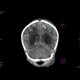 Meningencephalitis, abscessing: CT - Computed tomography